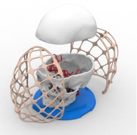 神经外科3D打印脑动脉瘤